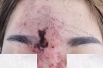 Hoại tử mũi và trán do tiêm filler