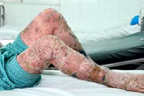 Uống thuốc tiêu độc thành nhiễm độc nặng