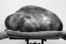 Tưởng béo bụng không ngờ “mang” u buồng trứng hơn 13kg.