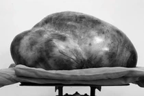 Tưởng béo bụng không ngờ “mang” u buồng trứng hơn 13kg.