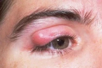 Hỏng mắt vì sát gấu quần trị chắp lẹo