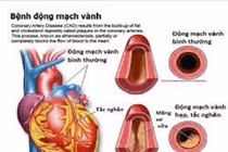 Xử lý bất thường lỗ xuất phát động mạch vành