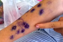 Thủy đậu người lớn chớ chủ quan