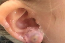 Họa hỏng tai vì làm đẹp xỏ lỗ