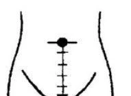 Chữa táo bón bằng xoa bóp bấm huyệt