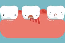 Giải pháp cải thiện chảy máu chân răng hay tái phát từ sản phẩm thiên nhiên