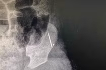 Kim khâu nằm sát xương cánh chậu