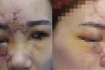 14 tuổi mù hai mắt và hoại tử mũi vì tiêm filler