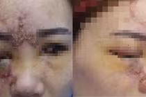 14 tuổi mù hai mắt và hoại tử mũi vì tiêm filler