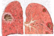 Áp xe phổi dễ vỡ và tử vong