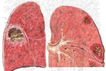 Áp xe phổi dễ vỡ và tử vong