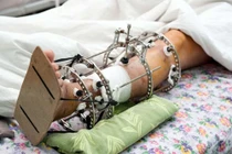 Nga phát triển thành công xương nhân tạo