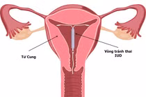 Vòng tránh thai chứa nội tiết tố