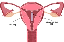 Vòng tránh thai chứa nội tiết tố