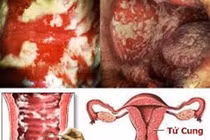  Vợ viêm âm đạo tái phát vì chồng không điều trị