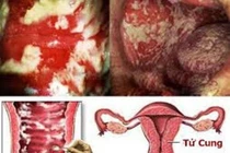  Vợ viêm âm đạo tái phát vì chồng không điều trị