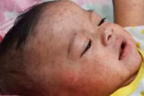  Chăm sóc để nốt sởi không lặn vào trong 