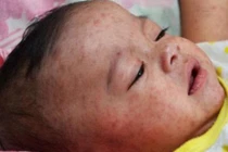  Chăm sóc để nốt sởi không lặn vào trong 