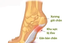  Viêm can gân chân