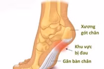  Viêm can gân chân