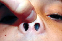 Cẩn thận u nhú mũi có xu hướng ác tính hóa