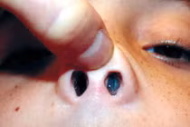 Cẩn thận u nhú mũi có xu hướng ác tính hóa