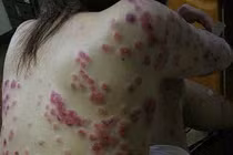 Căn bệnh xã hội ‘bị lãng quên’ nhưng cực kỳ nguy hiểm