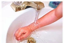 Bị bỏng do ngồi vào nồi canh