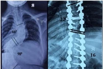 Cao thêm 11cm sau phẫu thuật chỉnh vẹo cột sống