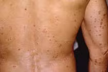 Nguyên nhân gây bệnh ngoài da