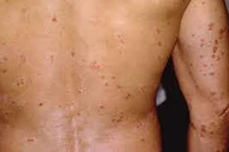 Nguyên nhân gây bệnh ngoài da