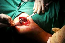 Chỉ định thay khớp vai khi đau 