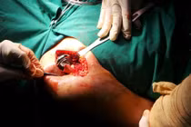 Chỉ định thay khớp vai khi đau 