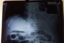 Cứu bệnh nhân tắc ruột và thoát vị hoành