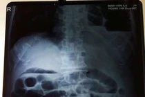 Cứu bệnh nhân tắc ruột và thoát vị hoành