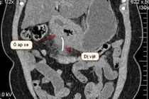 Nuốt tọt xương cá dài 5cm, người phụ nữ chỉ chậm chút nữa thì có thể tử vong