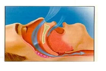 Khắc phục chứng ngủ ngáy