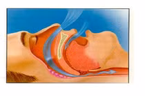 Khắc phục chứng ngủ ngáy