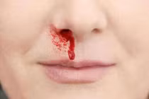 Tưởng chảy máu cam thông thường nào ngờ huyết áp gây tai biến