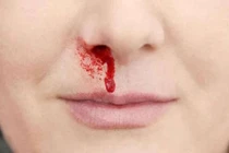 Tưởng chảy máu cam thông thường nào ngờ huyết áp gây tai biến