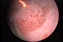 Chỉ định mổ u bàng quang khi chưa biết lành, ác