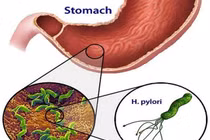  Nhiễm H.pylori vì dùng chung bát đũa