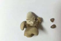 Mất thận vì 30 năm không điều trị sỏi