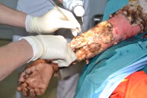 Đắp thuốc Nam, bệnh nhân bỏng bị nhiễm trùng nặng