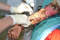 Đắp thuốc Nam, bệnh nhân bỏng bị nhiễm trùng nặng