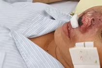 4 ca tử vong vì vi khuẩn "ăn thịt người": Không phải bùng phát về dịch bệnh 