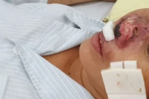 4 ca tử vong vì vi khuẩn "ăn thịt người": Không phải bùng phát về dịch bệnh 