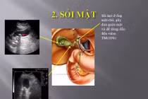 Phát hiện sớm sỏi túi mật tránh các biến chứng nguy hiểm tính mạng