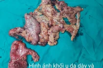 Ca lâm sàng hiếm gặp: Ung thư dạ dày kèm ung thư trực tràng