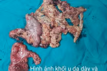 Ca lâm sàng hiếm gặp: Ung thư dạ dày kèm ung thư trực tràng